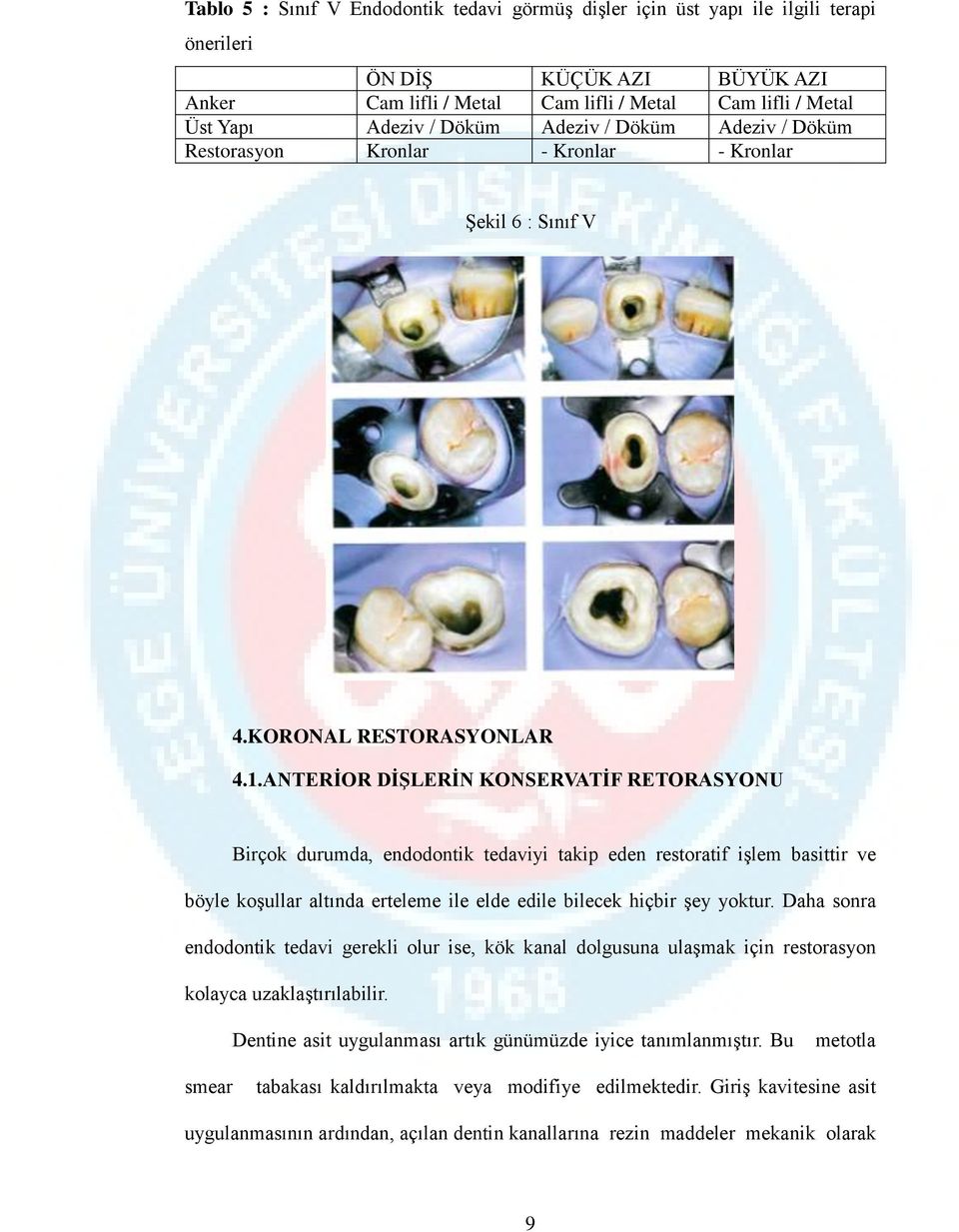 ANTERİOR DİŞLERİN KONSERVATİF RETORASYONU Birçok durumda, endodontik tedaviyi takip eden restoratif işlem basittir ve böyle koşullar altında erteleme ile elde edile bilecek hiçbir şey yoktur.