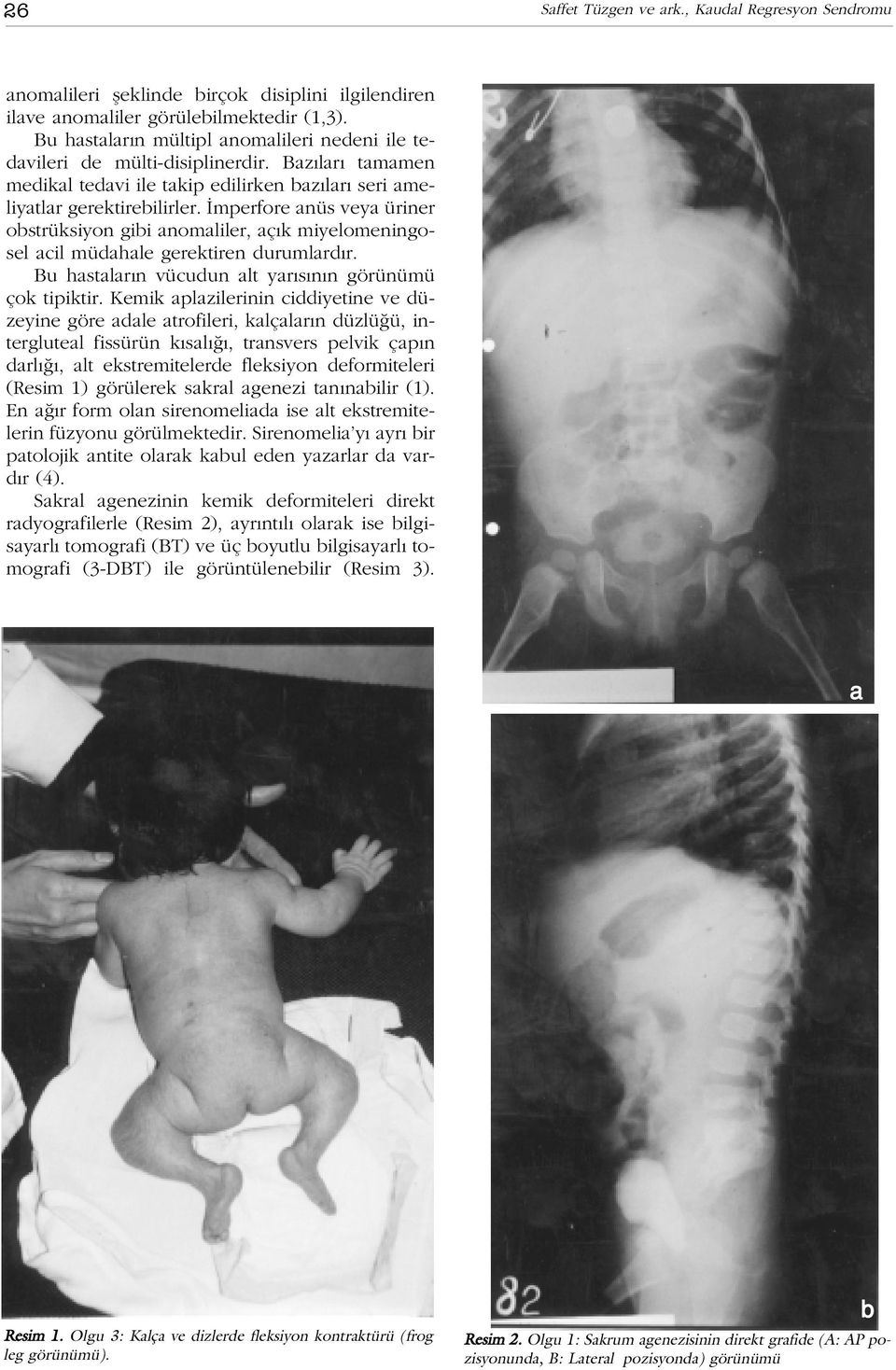 mperfore anüs veya üriner obstrüksiyon gibi anomaliler, aç k miyelomeningosel acil müdahale gerektiren durumlard r. Bu hastalar n vücudun alt yar s n n görünümü çok tipiktir.