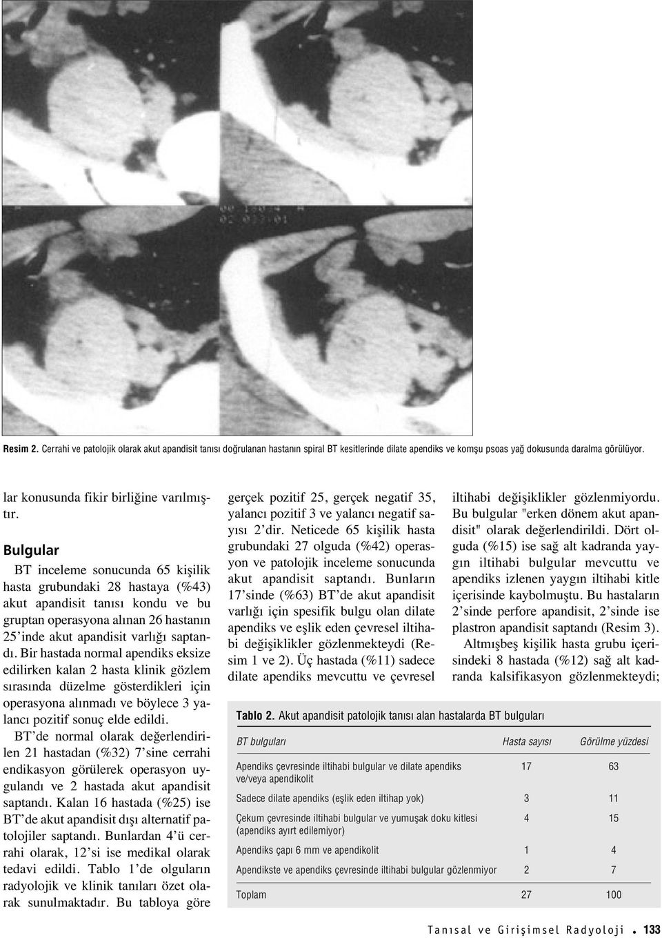 Bulgular BT inceleme sonucunda 65 kişilik hasta grubundaki 28 hastaya (%43) akut apandisit tan s kondu ve bu gruptan operasyona al nan 26 hastan n 25 inde akut apandisit varl ğ saptand.