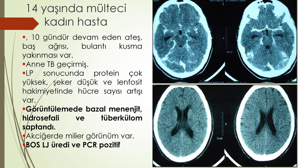 LP sonucunda protein çok yüksek, Ģeker düģük ve lenfosit hakimiyetinde hücre sayısı