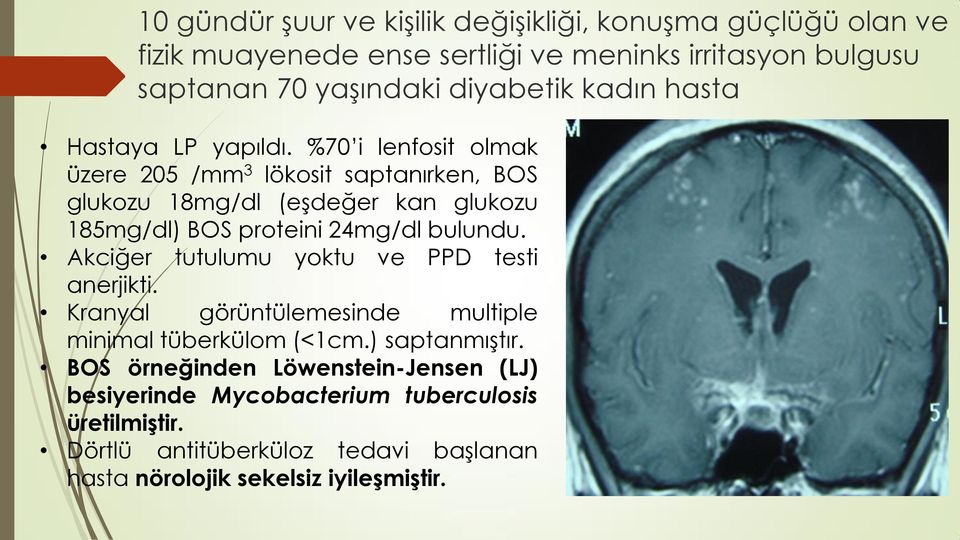 %70 i lenfosit olmak üzere 205 /mm 3 lökosit saptanırken, BOS glukozu 18mg/dl (eģdeğer kan glukozu 185mg/dl) BOS proteini 24mg/dl bulundu.