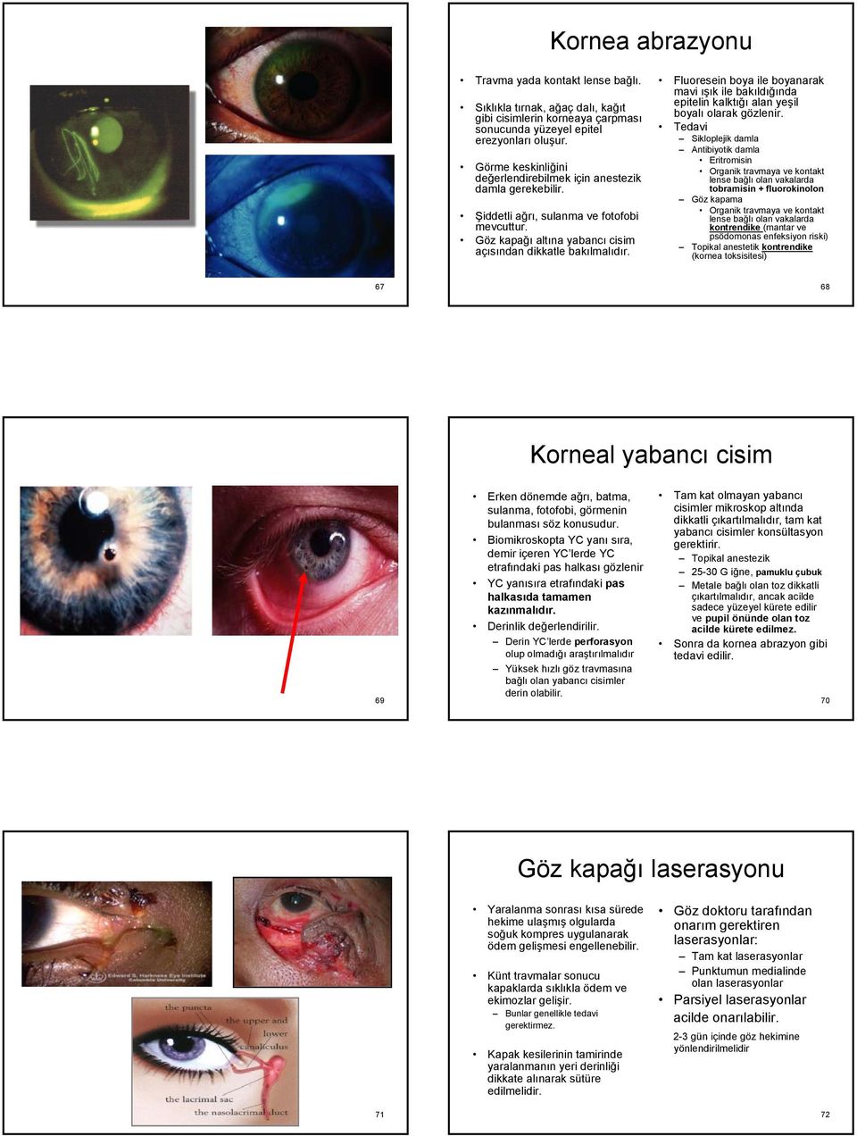 Fluoresein boya ile boyanarak mavi ışık ile bakıldığında epitelin kalktığı alan yeşil boyalı olarak gözlenir.