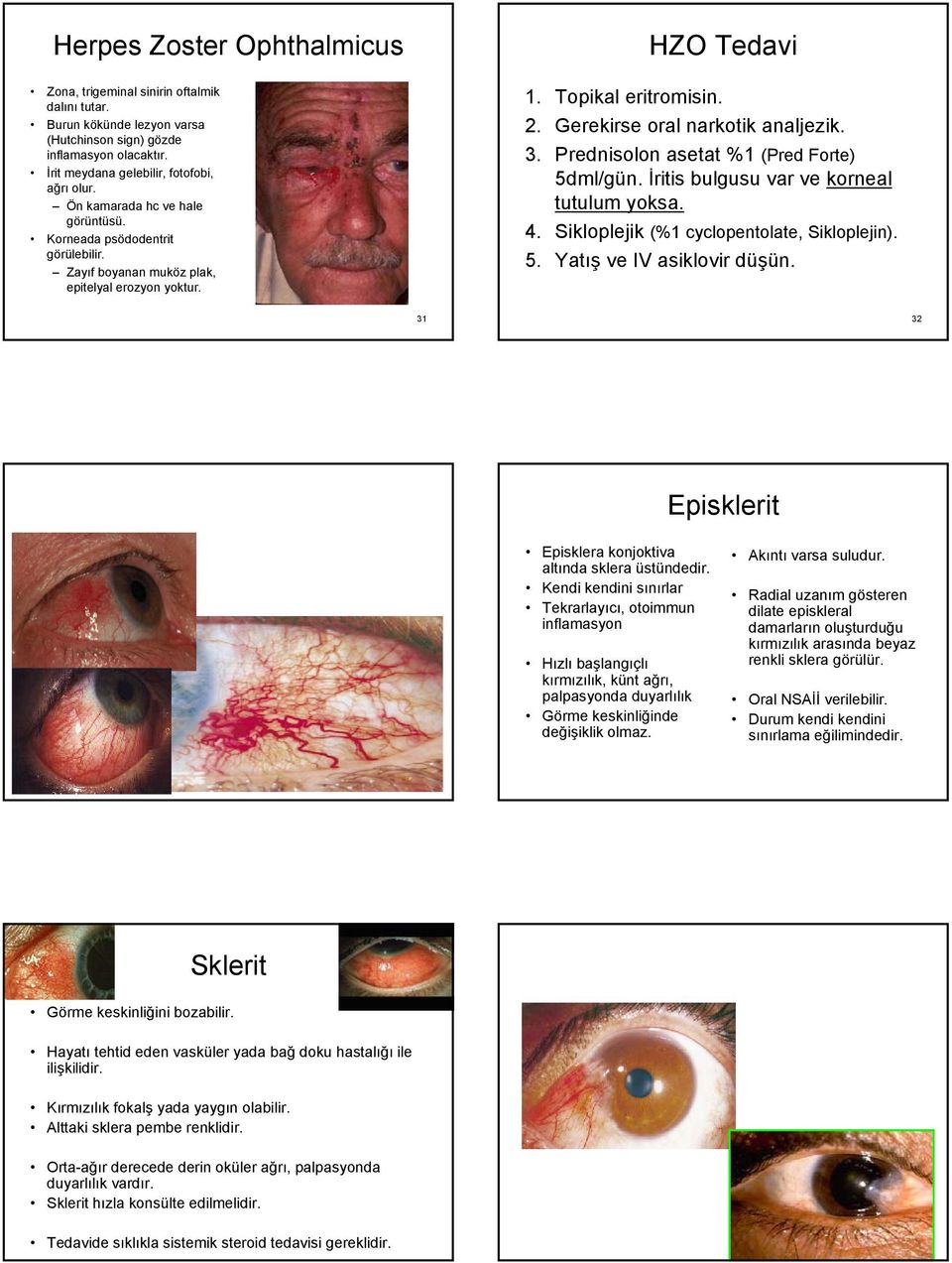 Prednisolon asetat %1 (Pred Forte) 5dml/gün. İritis bulgusu var ve korneal tutulum yoksa. 4. Sikloplejik (%1 cyclopentolate, Sikloplejin). 5. Yatış ve IV asiklovir düşün.