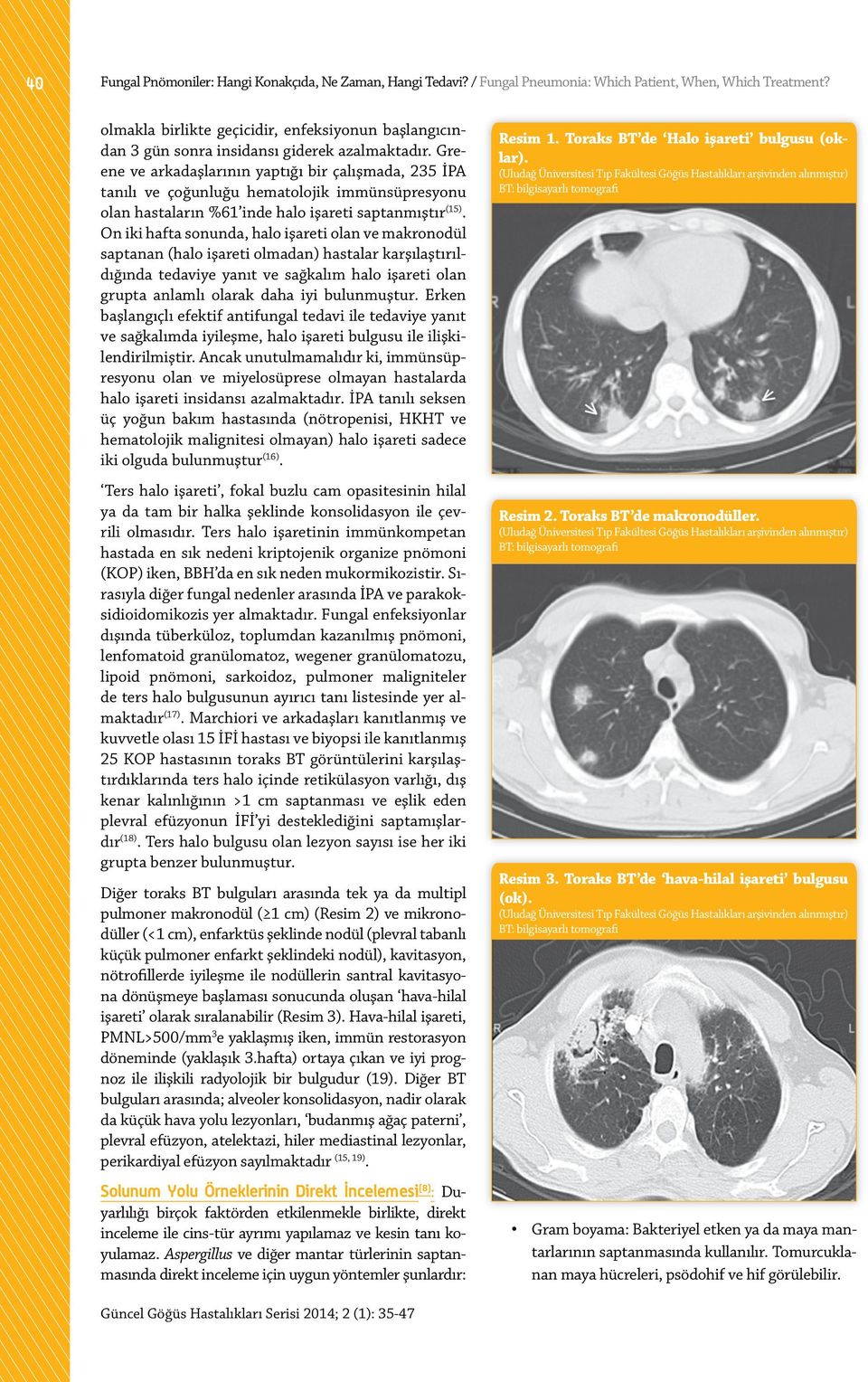 Greene ve arkadaşlarının yaptığı bir çalışmada, 235 İPA tanılı ve çoğunluğu hematolojik immünsüpresyonu olan hastaların %61 inde halo işareti saptanmıştır (15).