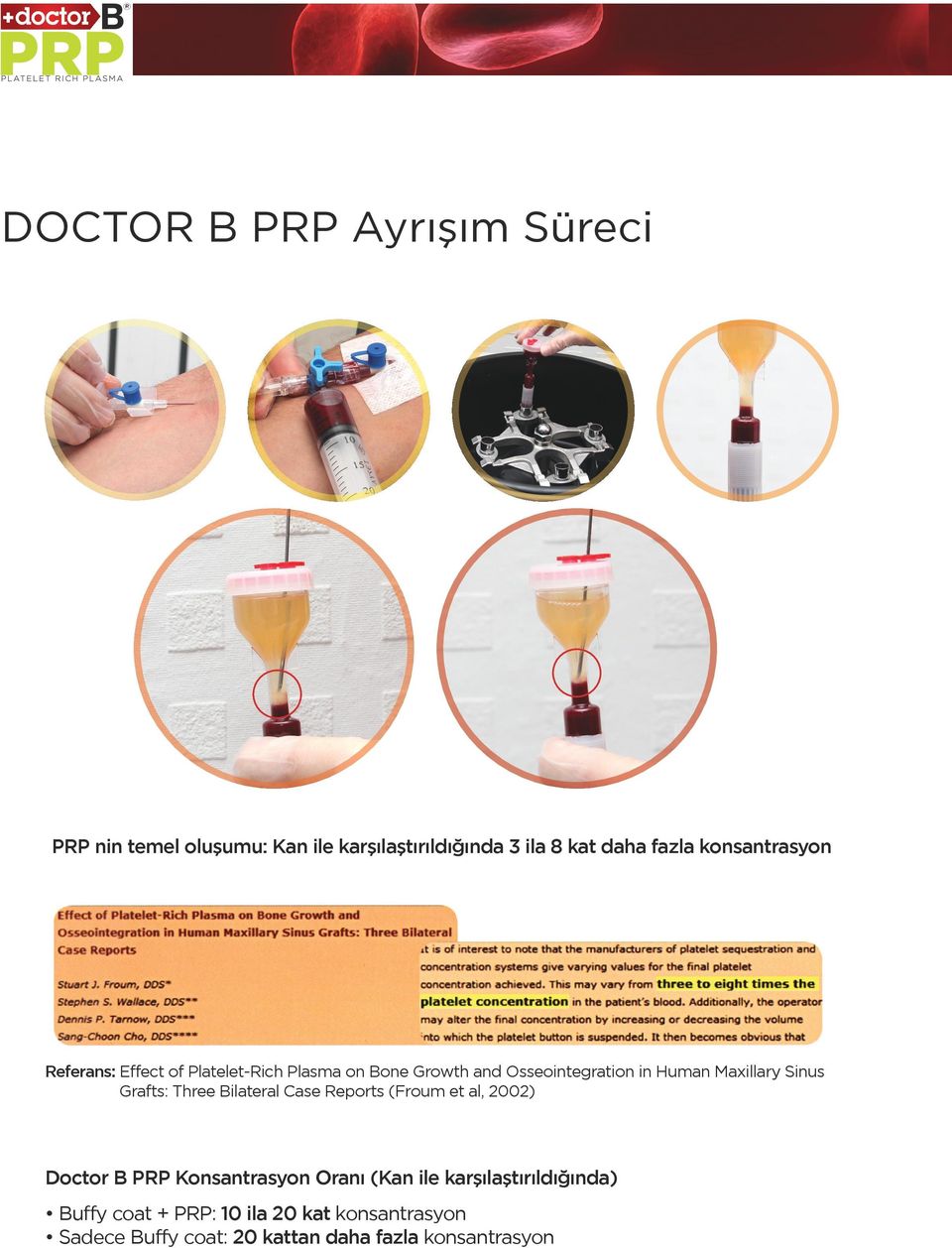 Sinus Grafts: Three Bilateral Case Reports (Froum et al, 2002) Doctor B PRP Konsantrasyon Oranı (Kan ile