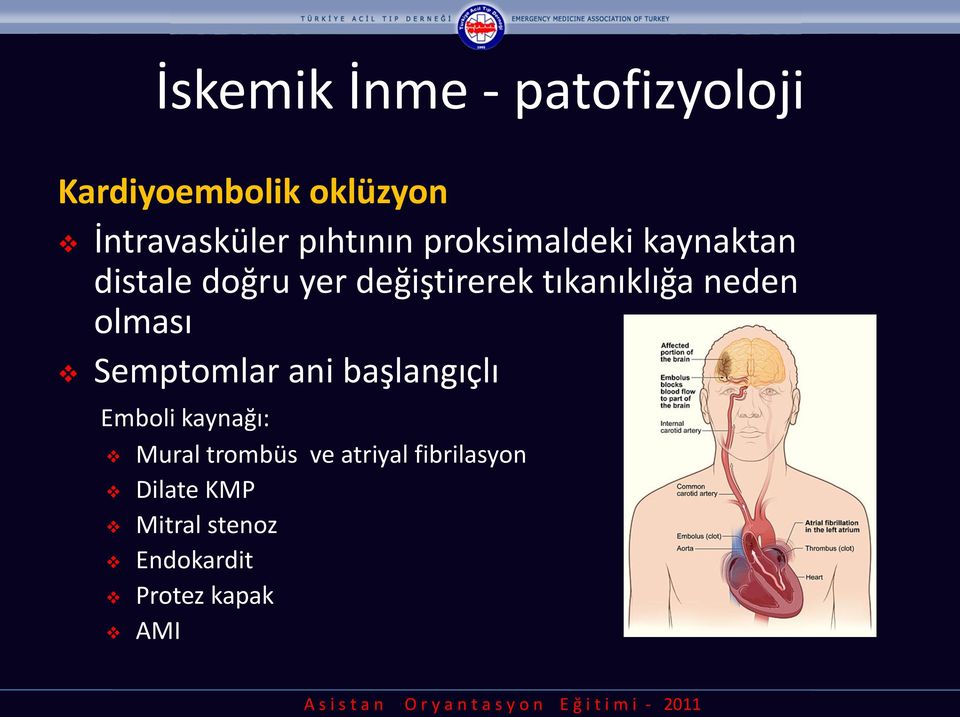 tıkanıklığa neden olması Semptomlar ani başlangıçlı Emboli kaynağı: