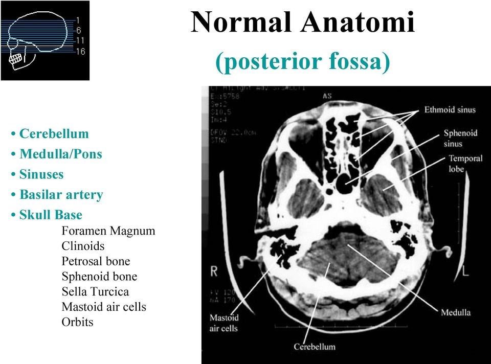 Base Foramen Magnum Clinoids Petrosal bone