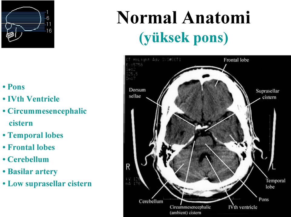 Temporal lobes Frontal lobes Cerebellum