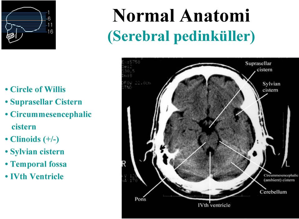 Circummesencephalic cistern Clinoids