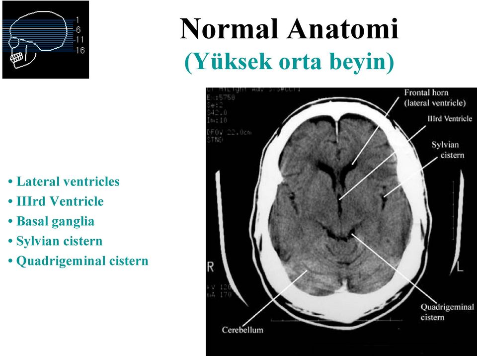 IIIrd Ventricle Basal ganglia