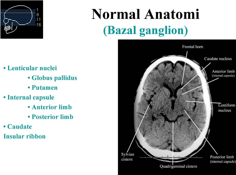 Putamen Internal capsule Anterior