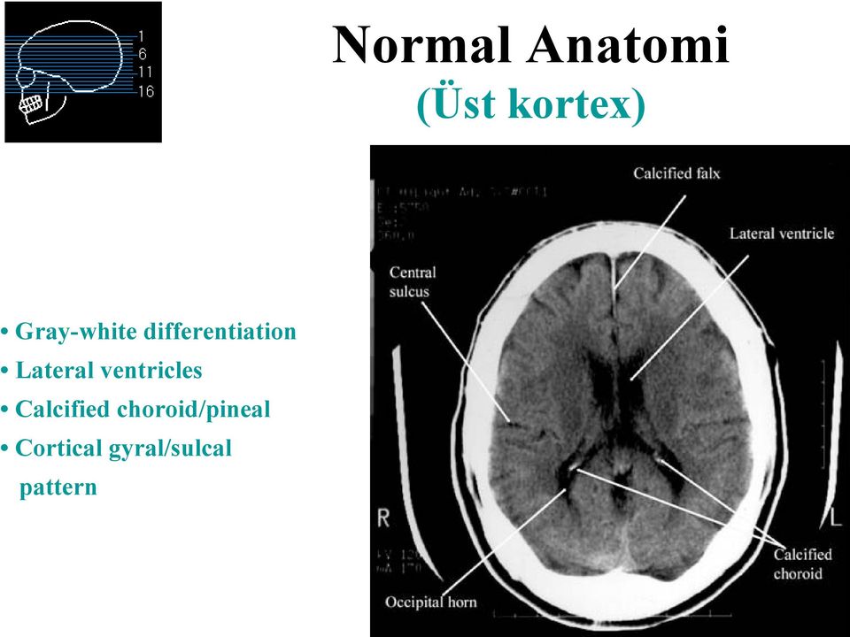 Lateral ventricles Calcified