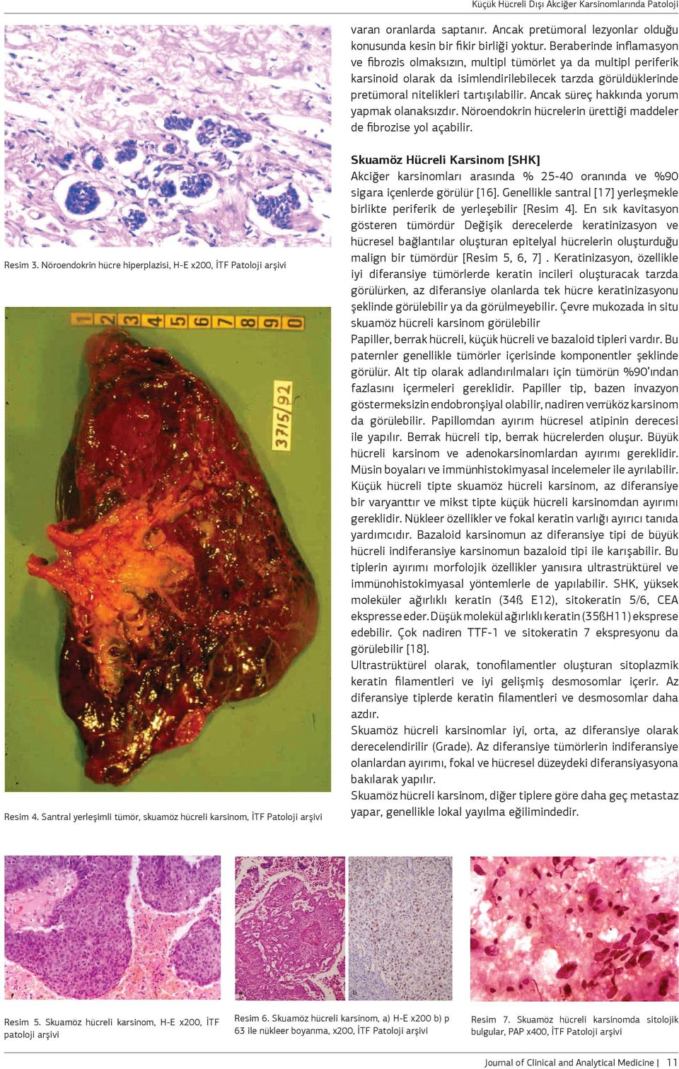 Ancak süreç hakkında yorum yapmak olanaksızdır. Nöroendokrin hücrelerin ürettiği maddeler de fibrozise yol açabilir. Resim 3. Nöroendokrin hücre hiperplazisi, H-E x200, İTF Patoloji arşivi Resim 4.