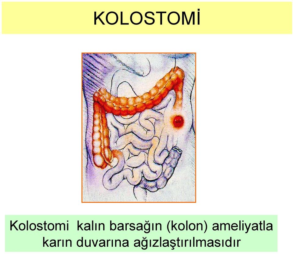 (kolon) ameliyatla