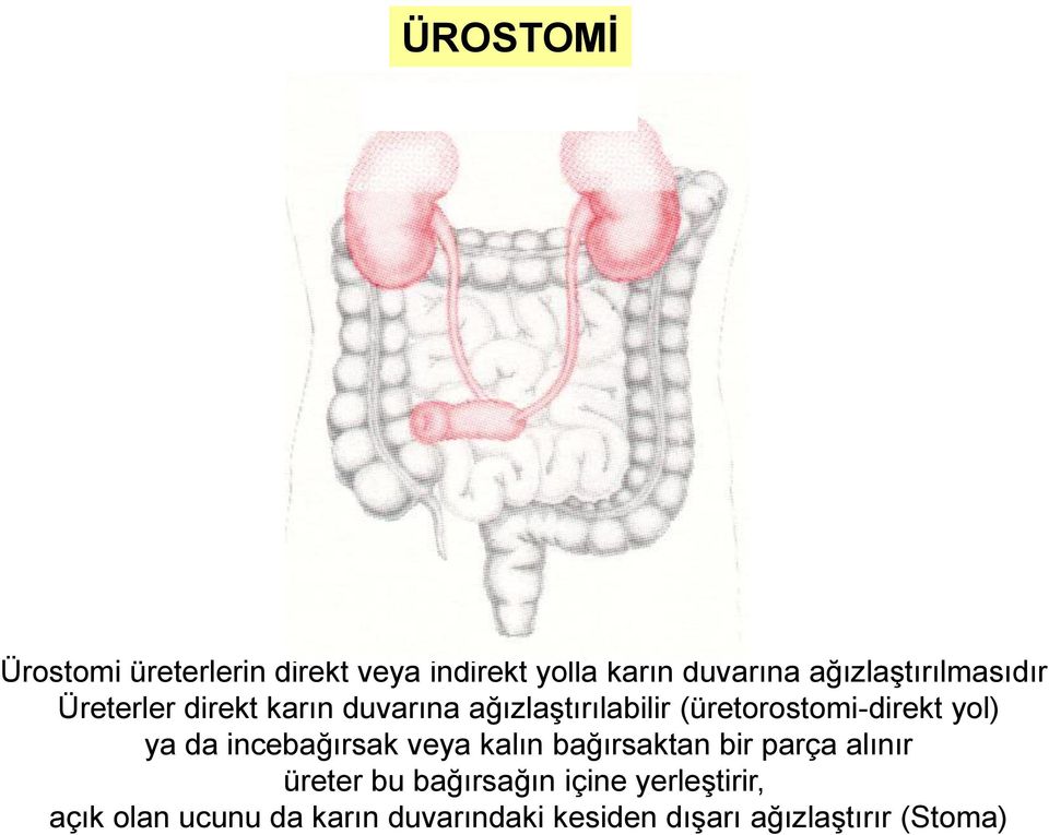 (üretorostomi-direkt yol) ya da incebağırsak veya kalın bağırsaktan bir parça alınır