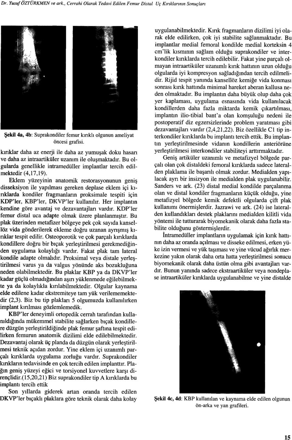 Eklem yüzeyinin anatomik restorasyonunun geniş ilisseksiyon ile yapılması gereken deplase eklem içi kınklarda kondiler fragınanların proksimale tespiti için KDP'ler, KBP'ler, DKVP'ler kullanılır.