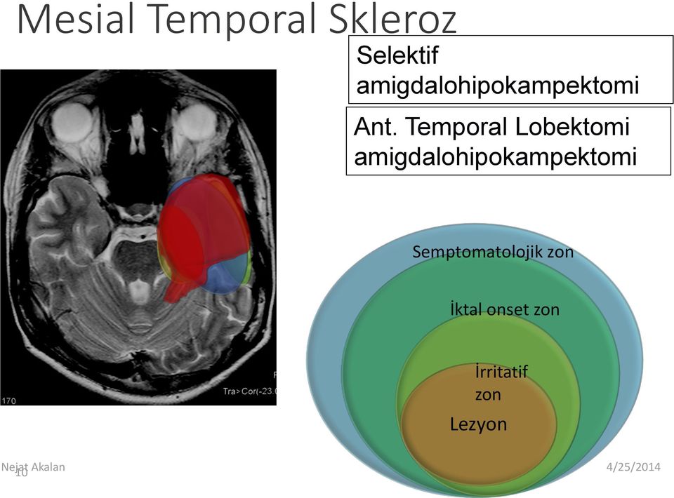 Temporal Lobektomi amigdalohipokampektomi