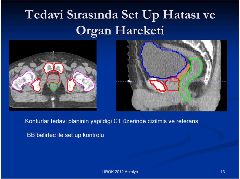 planinin yapildigi CT üzerinde