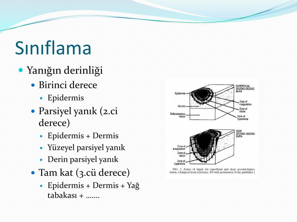 ci derece) Epidermis + Dermis Yüzeyel parsiyel