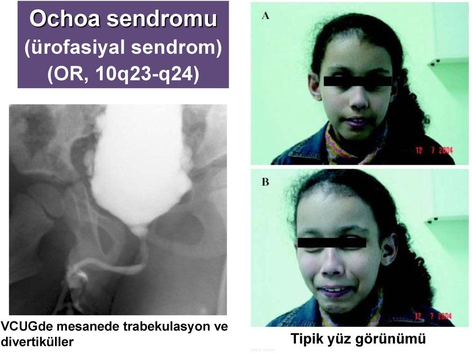 VCUGde mesanede trabekulasyon