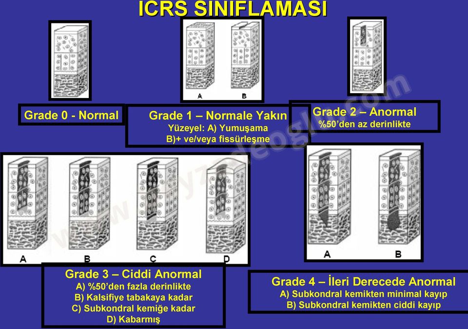 C) Subkondral kemiğe kadar D) Kabarmış Grade 2 Anormal %50 den az derinlikte Grade 4