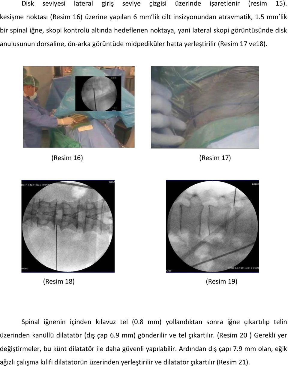 (Resim 16) (Resim 17) (Resim 18) (Resim 19) Spinal iğnenin içinden kılavuz tel (0.8 mm) yollandıktan sonra iğne çıkartılıp telin üzerinden kanüllü dilatatör (dış çap 6.