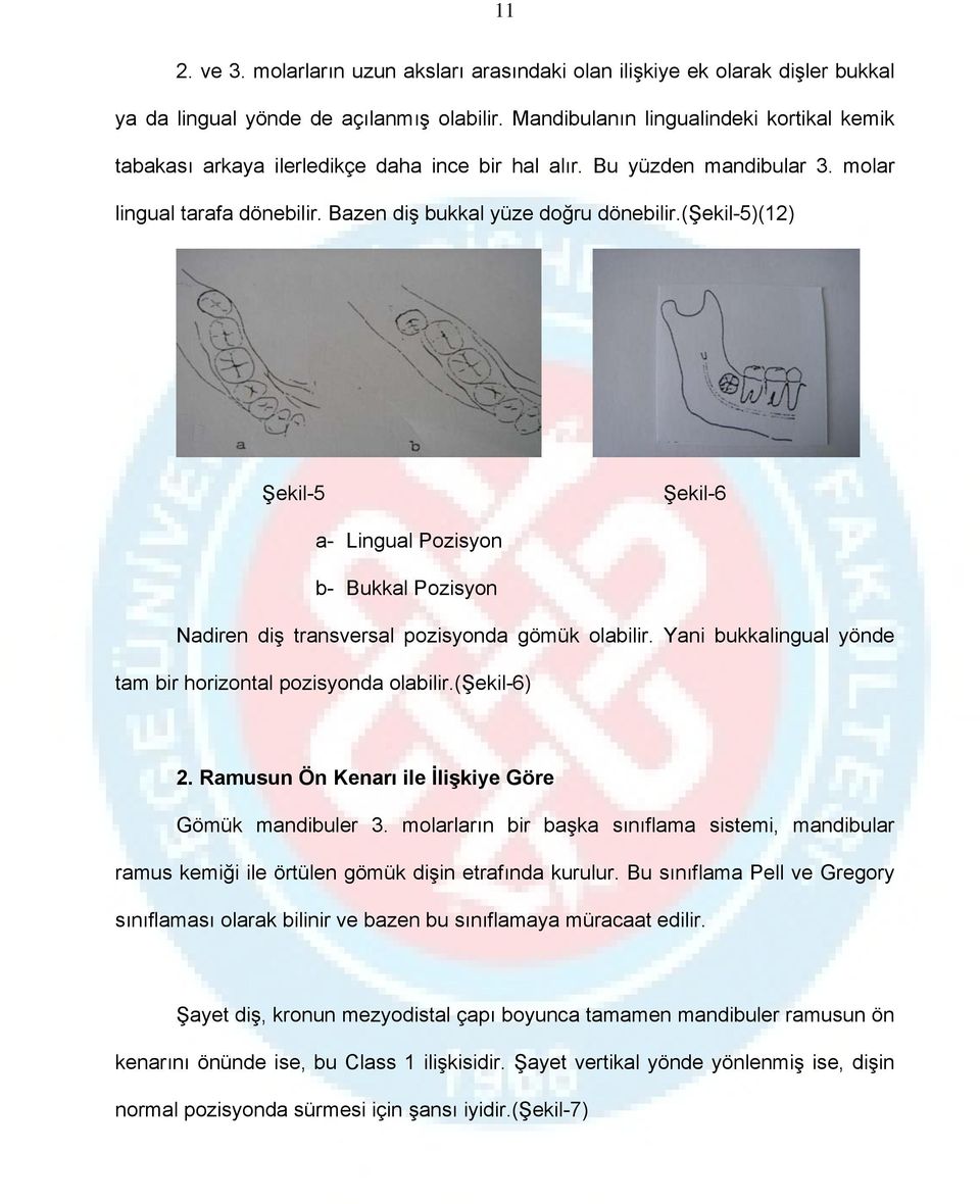 (şekil-5)(12) Şekil-5 Şekil-6 a- Lingual Pozisyon b- Bukkal Pozisyon Nadiren diş transversal pozisyonda gömük olabilir. Yani bukkalingual yönde tam bir horizontal pozisyonda olabilir.(şekil-6) 2.