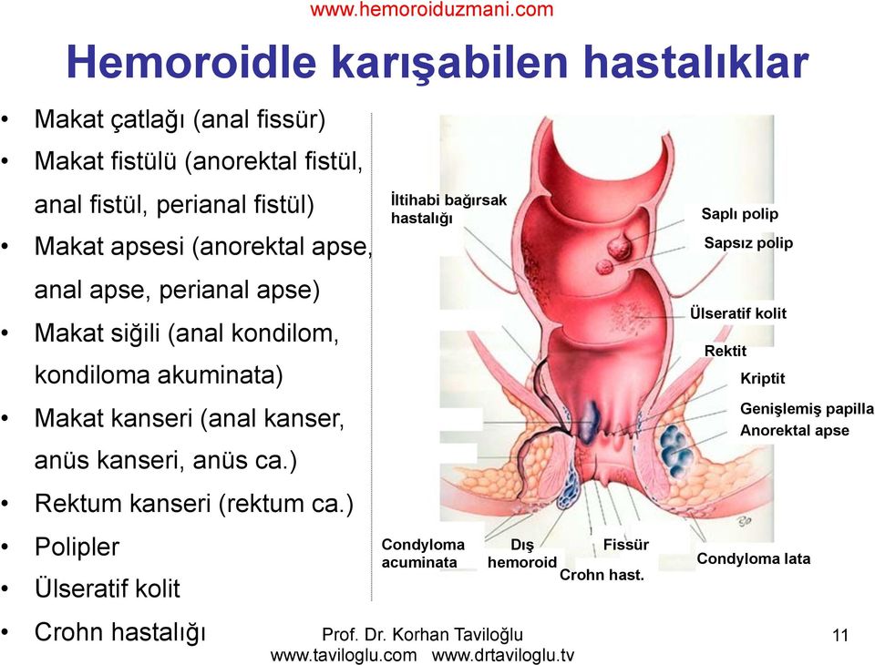 ca.) Rektum kanseri (rektum ca.) Polipler Ülseratif kolit Crohn hastalığı www.hemoroiduzmani.