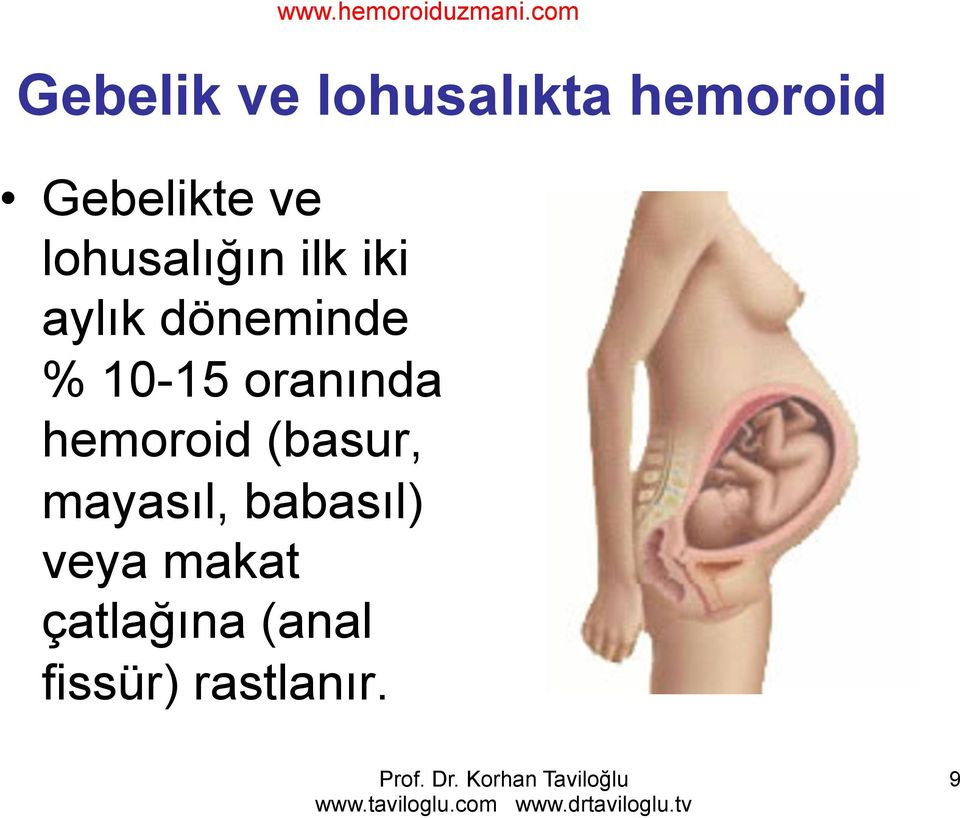 oranında hemoroid (basur, mayasıl, babasıl)