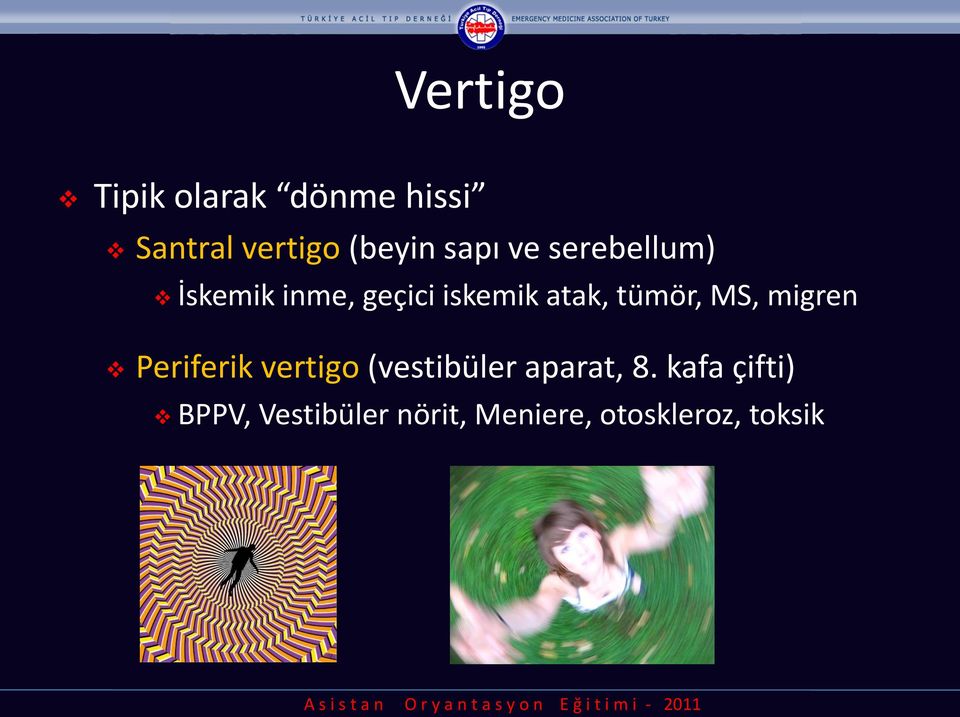 tümör, MS, migren Periferik vertigo (vestibüler aparat, 8.