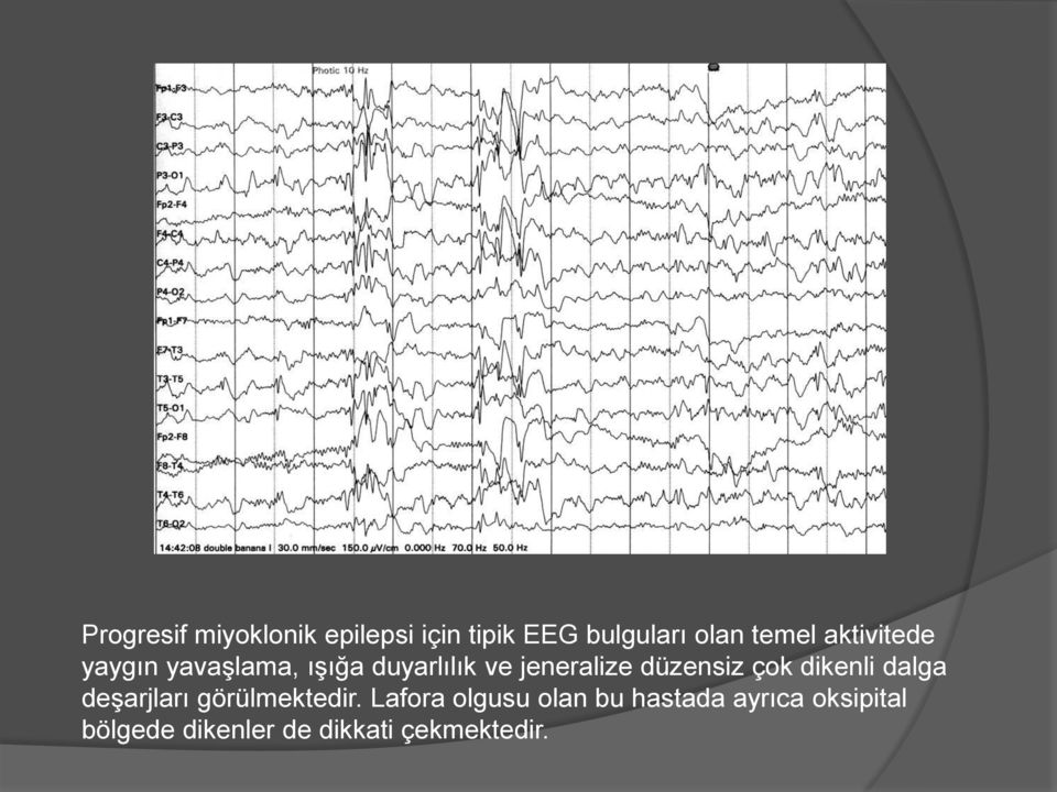 düzensiz çok dikenli dalga deşarjları görülmektedir.