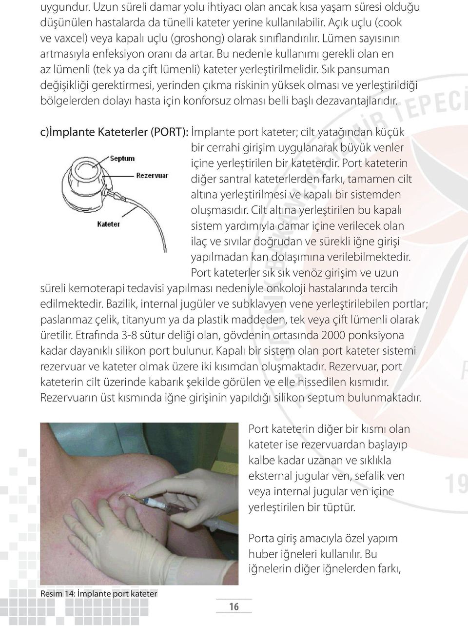 Bu nedenle kullanımı gerekli olan en az lümenli (tek ya da çift lümenli) kateter yerleştirilmelidir.