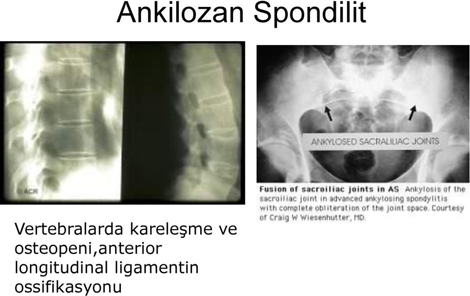 ve osteopeni,anterior