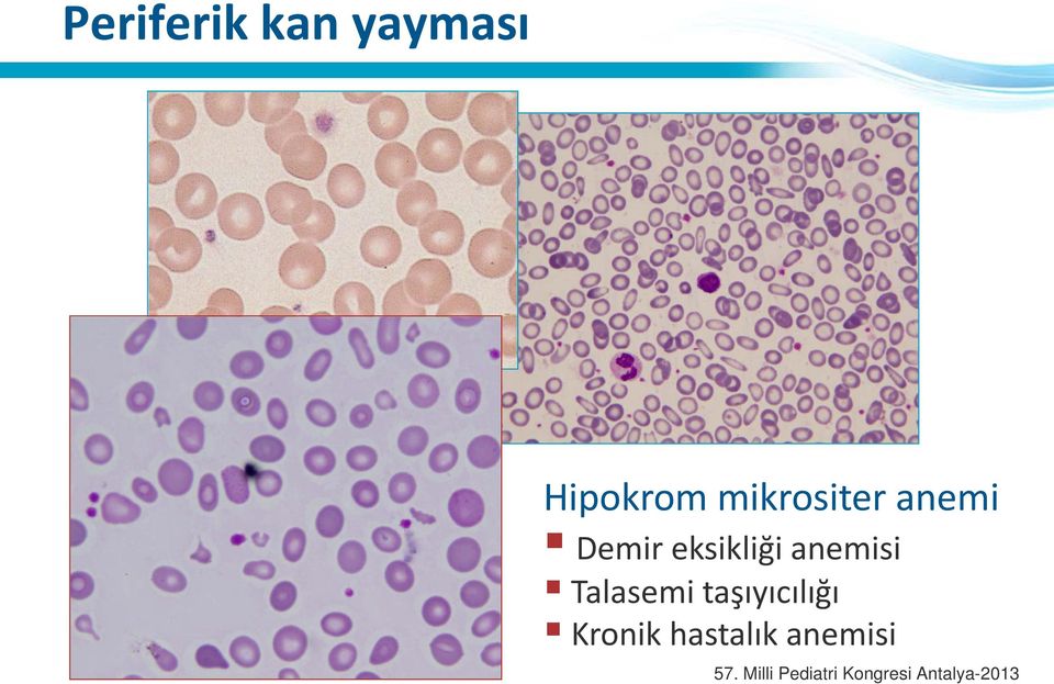 Demir eksikliği anemisi