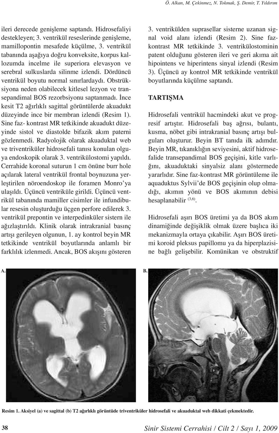 Obstrüksiyona neden olabilecek kitlesel lezyon ve transepandimal BOS rezorbsiyonu saptanmadı. İnce kesit T2 ağırlıklı sagittal görüntülerde akuadukt düzeyinde ince bir membran izlendi (Resim 1).