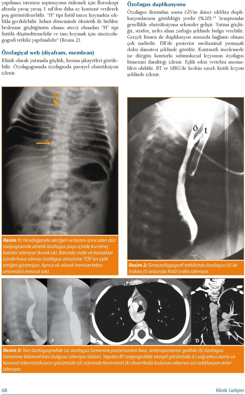 Özofagiyal web (diyafram, membran) Klinik olarak yutmada güçlük, kusma şikayetleri görülebilir. Özofagogramda özofagusda parsiyel obstrüksiyon izlenir.