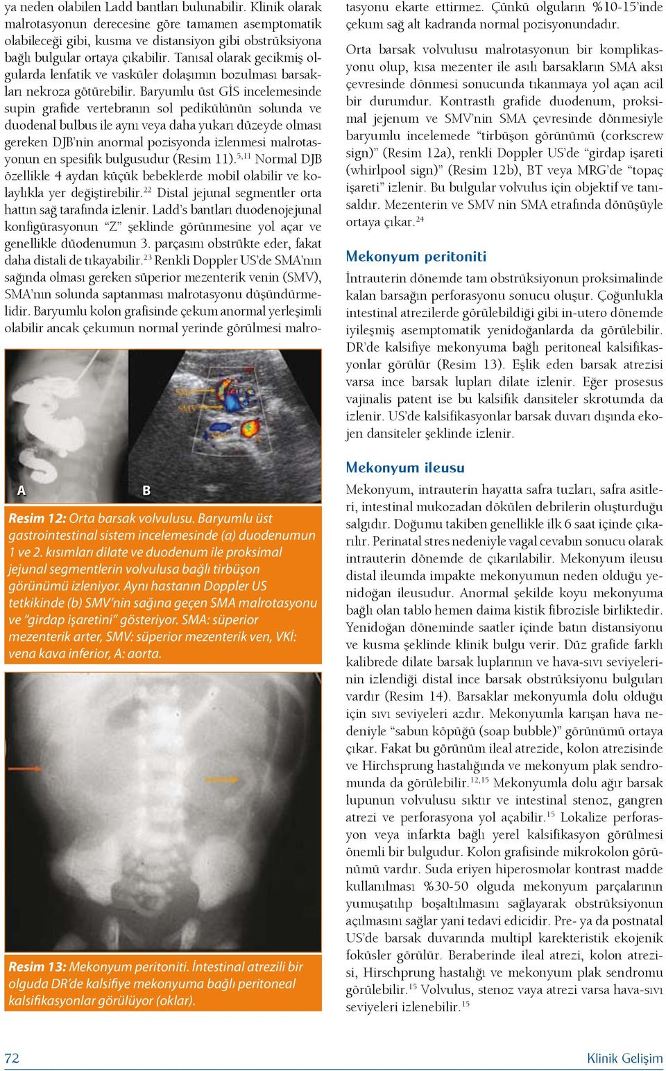 Aynı hastanın Doppler US tetkikinde (b) SMV nin sağına geçen SMA malrotasyonu ve girdap işaretini gösteriyor.