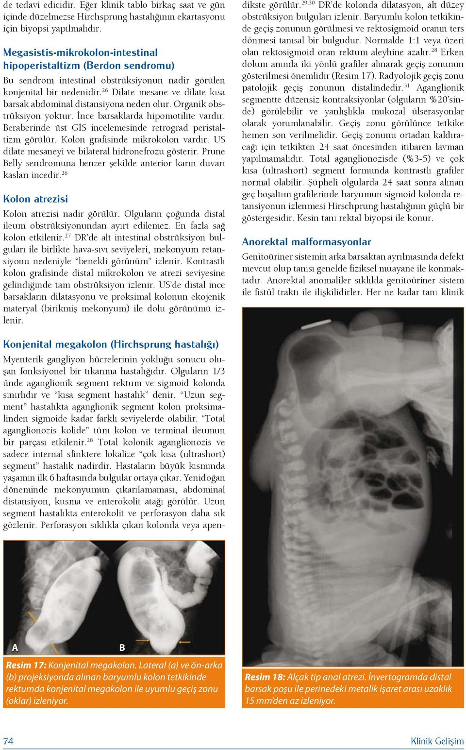 26 Dilate mesane ve dilate kısa barsak abdominal distansiyona neden olur. Organik obstrüksiyon yoktur. İnce barsaklarda hipomotilite vardır.