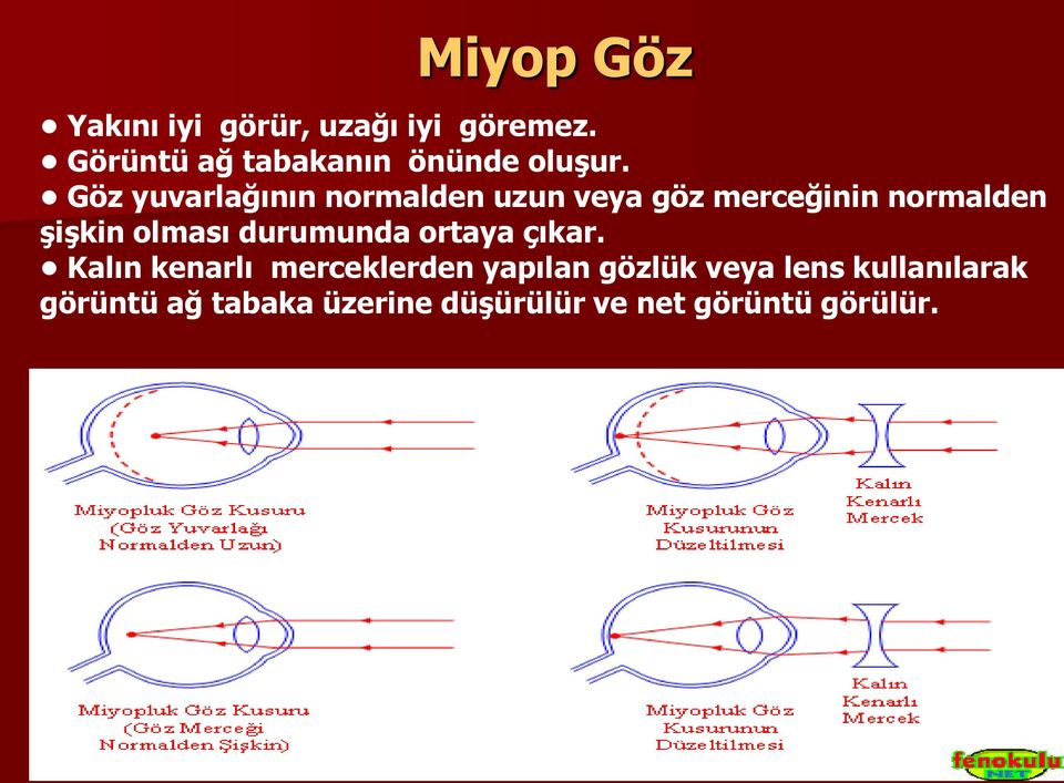 Göz yuvarlağının normalden uzun veya göz merceğinin normalden şişkin olması