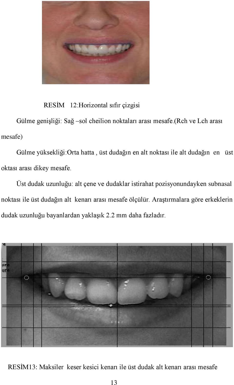 Üst dudak uzunluğu: alt çene ve dudaklar istirahat pozisyonundayken subnasal noktası ile üst dudağın alt kenarı arası mesafe