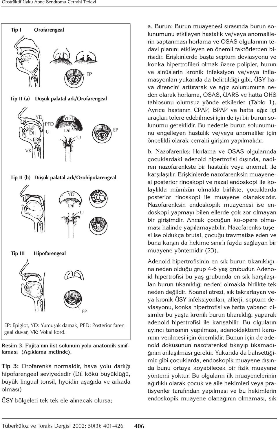 Düşük palatal ark/orofarengeal U YD Dil Tip II (b) Düşük palatal ark/orohipofarengeal Tip III Hipofarengeal YD Dil EP: Epiglot, YD: Yumuşak damak, PFD: Posterior farengeal duvar, VK: Vokal kord.