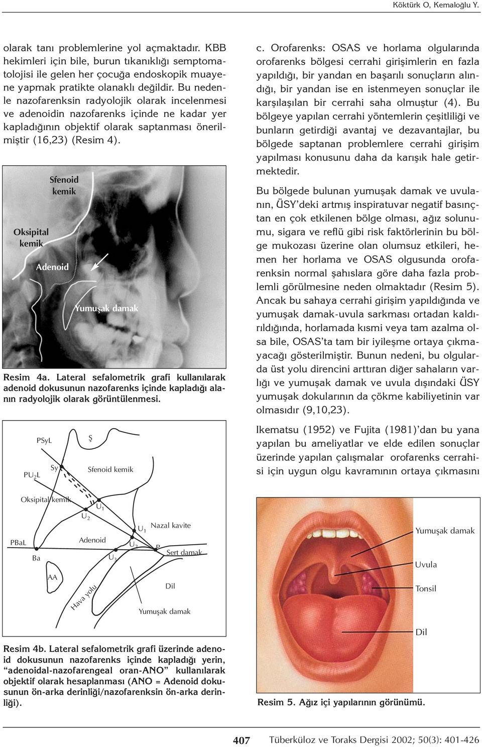 Oksipital kemik Sfenoid kemik Adenoid Yumuşak damak Resim 4a. Lateral sefalometrik grafi kullanılarak adenoid dokusunun nazofarenks içinde kapladığı alanın radyolojik olarak görüntülenmesi. c.