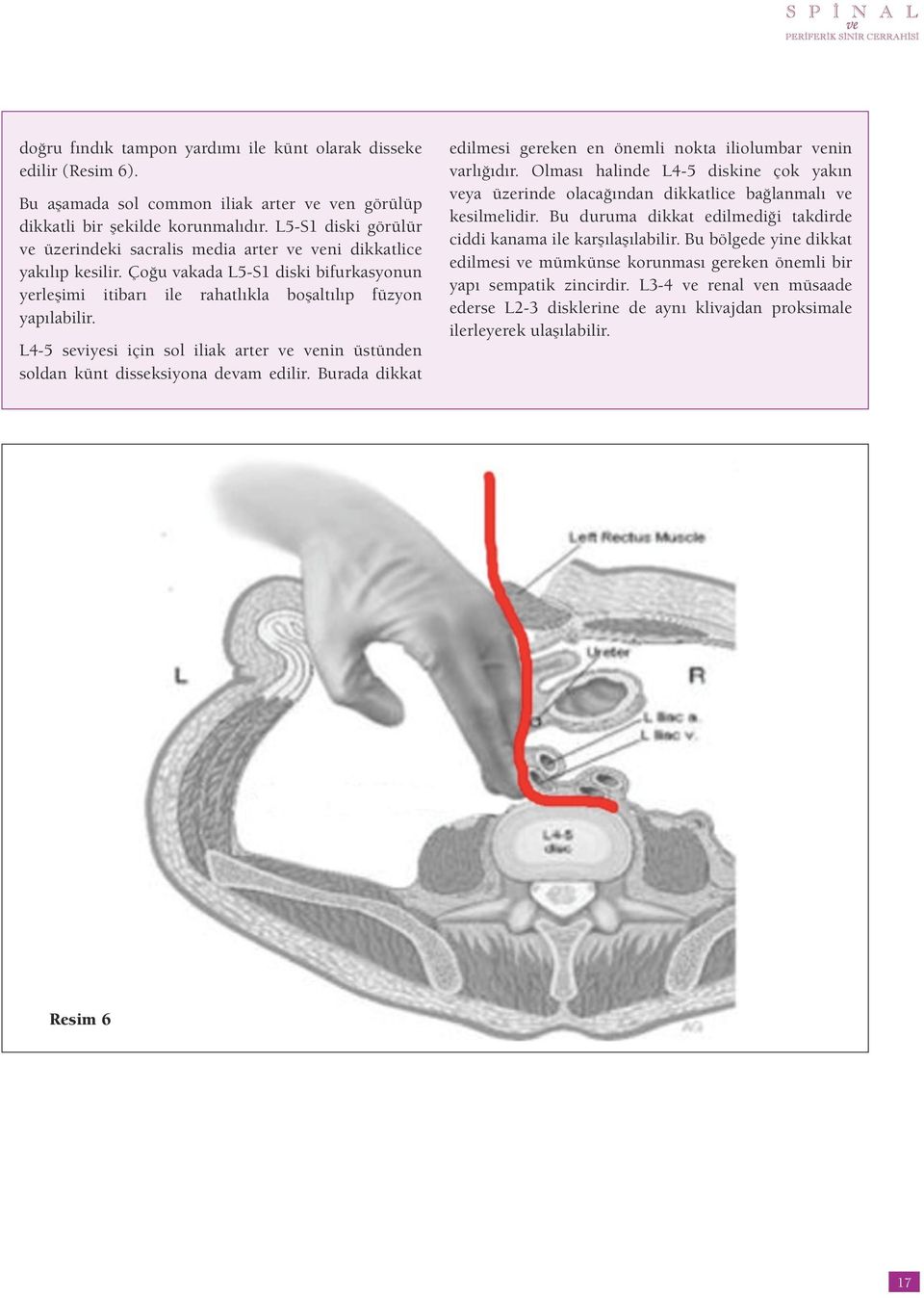 L4-5 seviyesi için sol iliak arter ve venin üstünden soldan künt disseksiyona devam edilir. Burada dikkat edilmesi gereken en önemli nokta iliolumbar venin varlığıdır.