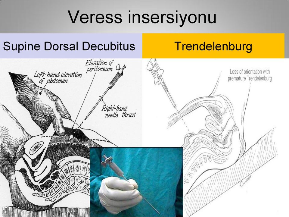 Supine Dorsal