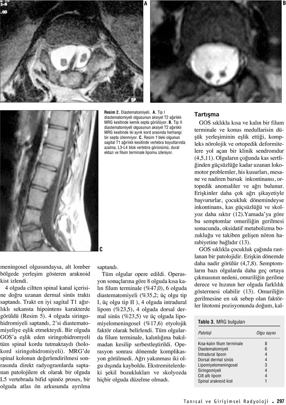 Bir olguda GOS a eşlik eden siringohidromyeli tüm spinal kordu tutmaktayd (holokord siringohidromiyeli).