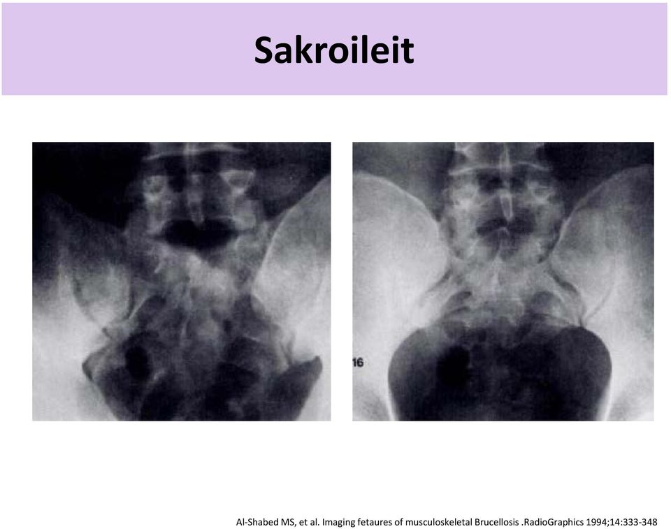 musculoskeletal Brucellosis.