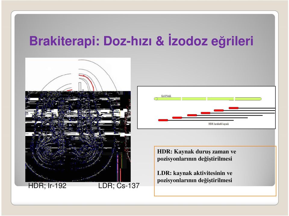 değiştirilmesiğ HDR; Ir-192 LDR; Cs-137 LDR: