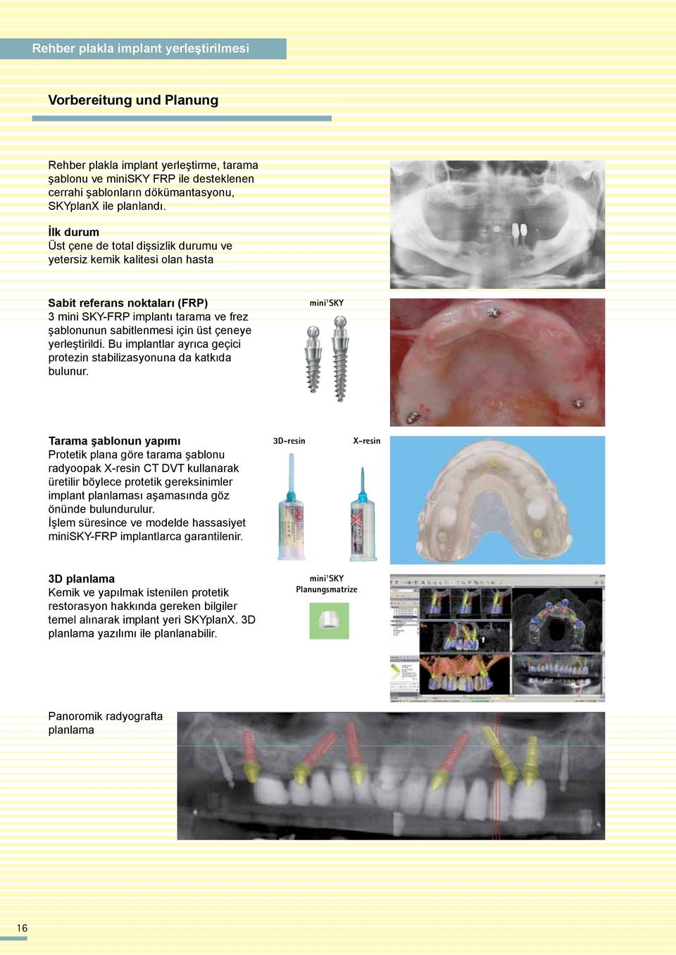 İlk durum Üst çene de total dişsizlik durumu ve yetersiz kemik kalitesi olan hasta Sabit referans noktaları (FRP) 3 mini SKY-FRP implantı tarama ve frez şablonunun sabitlenmesi için üst çeneye