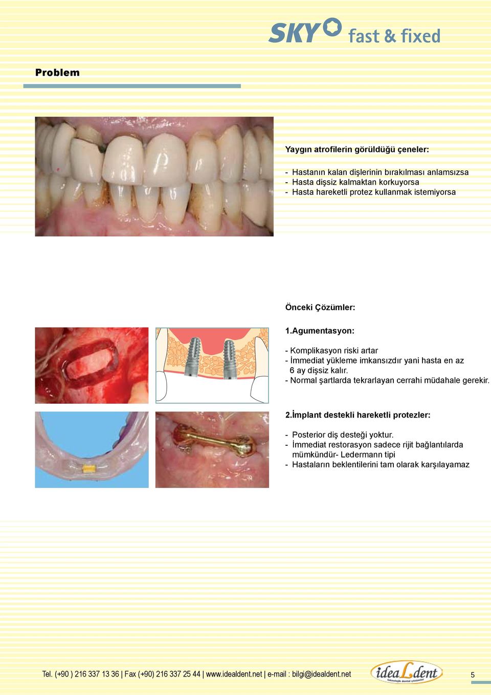 - Normal şartlarda tekrarlayan cerrahi müdahale gerekir. 2.İmplant destekli hareketli protezler: - Posterior diş desteği yoktur.