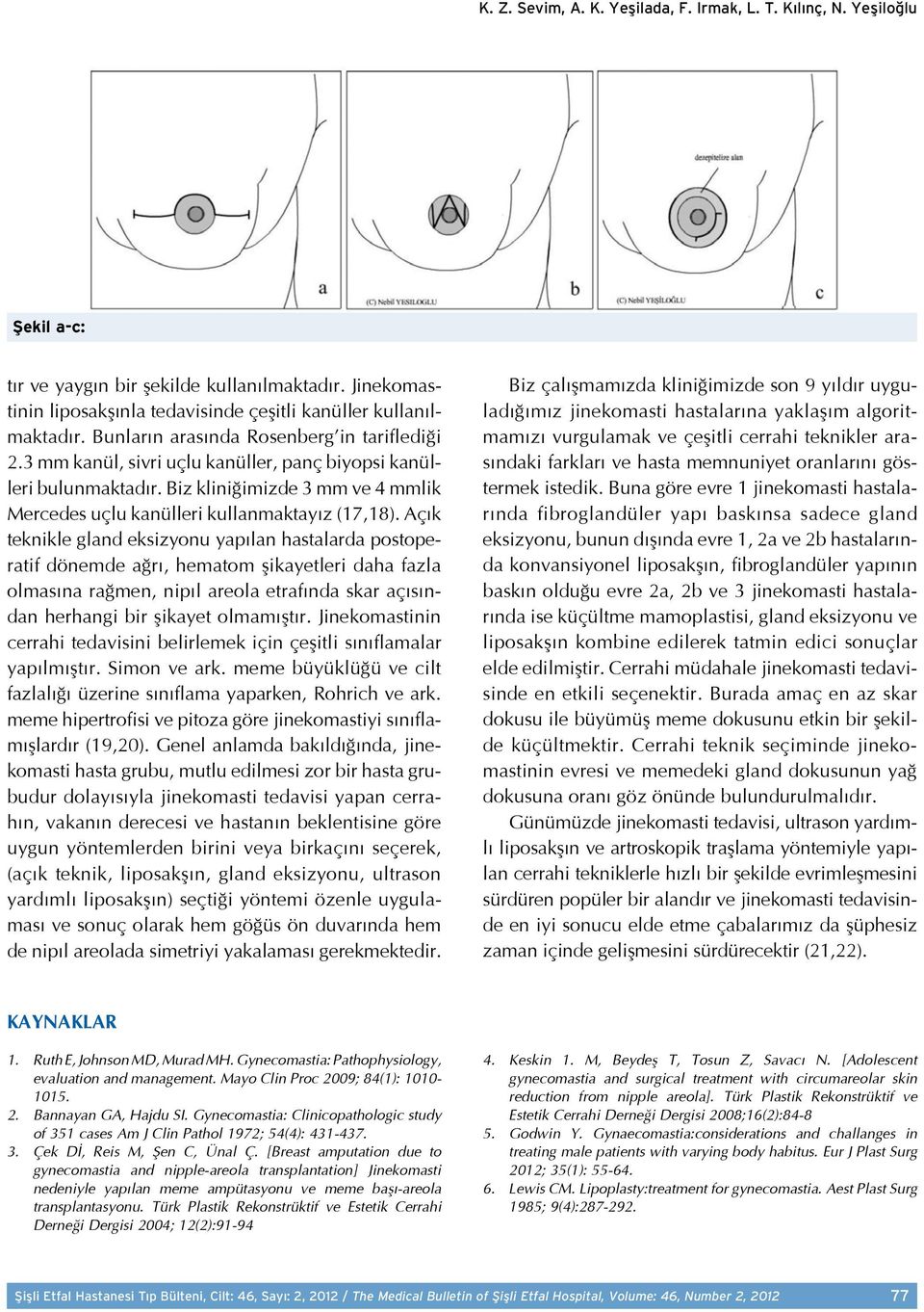 Açık teknikle gland eksizyonu yapılan hastalarda postoperatif dönemde ağrı, hematom şikayetleri daha fazla olmasına rağmen, nipıl areola etrafında skar açısından herhangi bir şikayet olmamıştır.